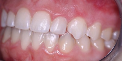After Image: Composite Restoration - front