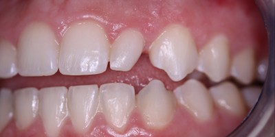 Before Image: Composite Restoration - front