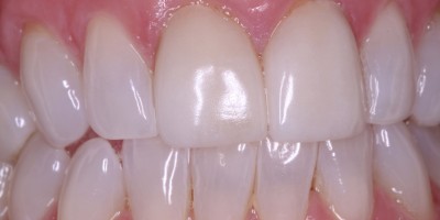 After Image: Laser Contouring,Veneers - front