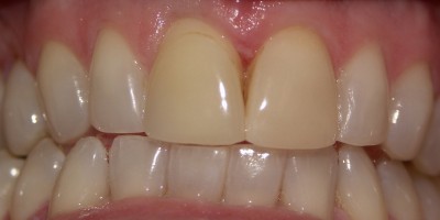 Before Image: Laser Contouring,Veneers - front