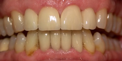 After Image: Veneers - front