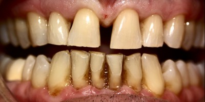 Before Image: Veneers - front