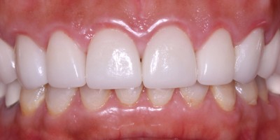 After Image: Veneers - front