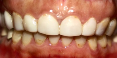 Before Image: Veneers - front