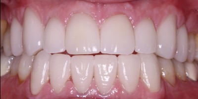 After Image: Veneers - front