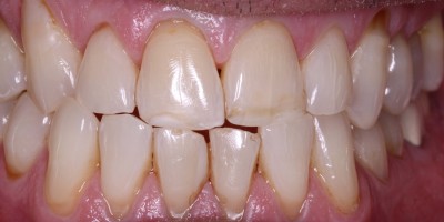 Before Image: Veneers - front